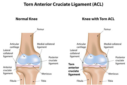ACL_injury