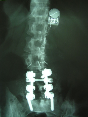 Spinal fusion physical therapy